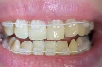 Brackets estéticos