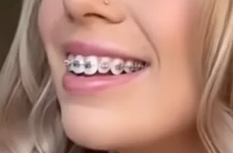 Brackets metálicos
